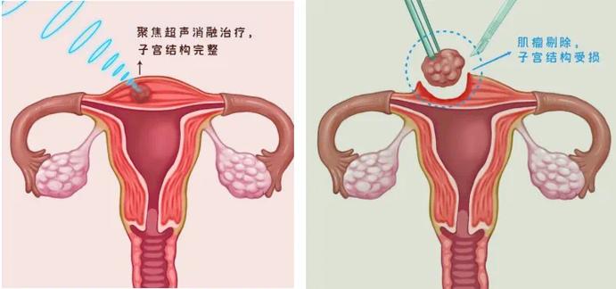 保法医院添利器——“海扶刀”应用于临床